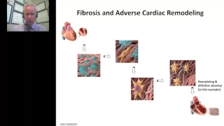 Peter McCullough - Galectin 3 A Step Towards a Clearer Pathway in Heart Failure Management