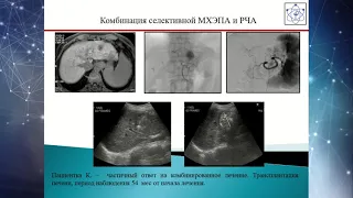 Ссесия 5 Гепатоцеллюлярный рак Что нового