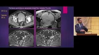 Можливості мультипараметричної МРТ у діагностиці раку сечового міхура