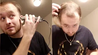 BALDING AT 20 - Going Bald And Shaving My Head for good