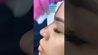 LIQUID RHINOPLASTY: BEAUTIFUL RESULTS!