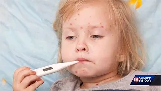 Doctor advises against 'Chicken Pox Parties'