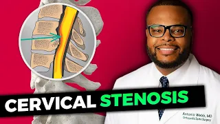 What is Cervical Stenosis? | Antonio Webb, M.D.