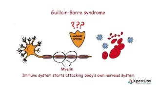 Guillain Barre Syndrome - Where body's immune system attacks its nervous system