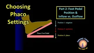 Phaco Fundamentals Part 2: Foot Pedal Position & Inflow vs Outflow