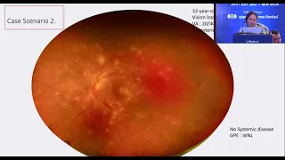 Posterior & Pan Uveitis (How do I approach? / What Investigations & Treatment?)