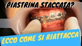 Piastrina staccata? Ecco come si riattacca