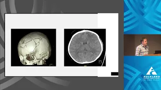 Emergency Management of Severe Head Trauma