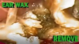 Most Irritating Ear Wax  Deep Impacted Hard Stuck Ear Wax Removal.(Keep Healthy ear wax) Spa EP364