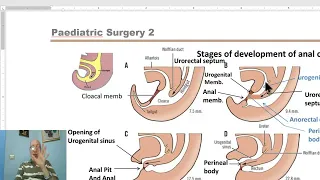 Paediatric surgery in Arabic 11 ( Anorectal malformations, part 1) ,  by Dr, Wahdan