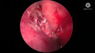 Endonasal dcr for lacrimal mucocele,common canalicular block,revision dcr - Dr Babu AR JSSMC Mysuru