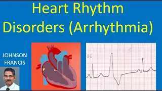 Heart Rhythm Disorders (Arrhythmia)