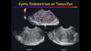 Ultrasound of the Endometrium