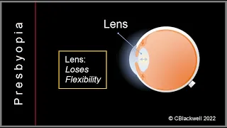 Presbyopia 1: Why Do We Need Reading Glasses?