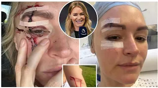 Laura Woods won't host Tyson Fury vs Oleksandr Usyk after suffering horror injury