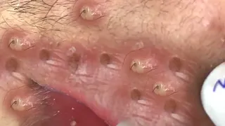 Clean Giant Blackheads on on the Lips