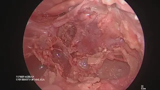 Module 11 Cavernous Sinus Dissection