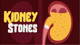 Kidney Pain? How to treat Kidney Stones? Causes and Symptoms