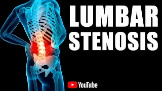 Lumbar Stenosis BEST Stretches, Exercises & Treatments. Common Symptoms & Physical Therapy Exercises