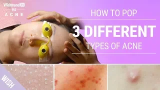 How to Extract 3 Different Types of Acne as Told By A Dermatologist | Wishtrend TV vs Acne