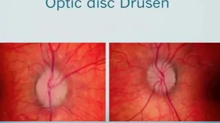 AIOC2018 - IC440 - Topic - Keynote Address by Dr. VINEETA MUNSHI : “Optic Disc Abnormalities .."