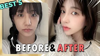 5 AMAZING Korean Plastic Surgery Transformation |Dramatic Makeover Before and After Results in Korea