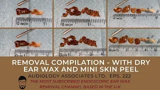 EAR WAX REMOVAL COMPILATION - WITH DRY EAR WAX AND MINI SKIN PEEL - EP 222