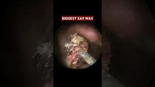 Biggest Ear Wax Removal  EP2 #shots #earwax