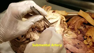 Submandibular Salivary Gland – Triangle HD Demonstration and Surgical Narration – Sanjoy Sanyal