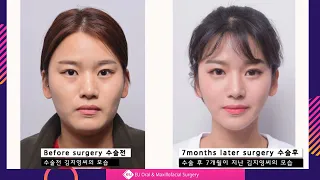 Facial Contouring - V-line Surgery &  Cheekbone Reduction Surgery Review