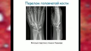 Перелом костей запястья: #травматологии_и_ортопедии