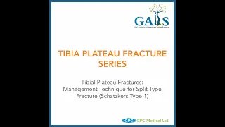 Tibial Plateau Fracture Series: Management Techniques for Split Type Fractures (Schalzker’s Type 1)