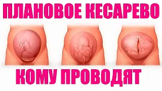 ПЛАНОВОЕ КЕСАРЕВО СЕЧЕНИЕ | Кому нужно и как проводится плановое кесарево сечение