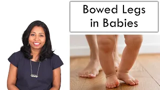 Bowed Legs in Babies – Reason & Cure