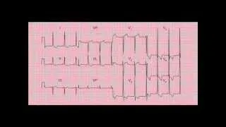 Examples to master 12 lead ECG / EKG interpretation - workshop 3