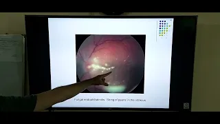 Endophthalmitis Post op after cataract surgery