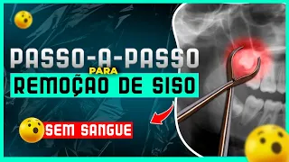 Técnica de Remoção do Terceiro Molar Inferior / Siso - Passo-a-passo SEM SANGUE em 10 minutos