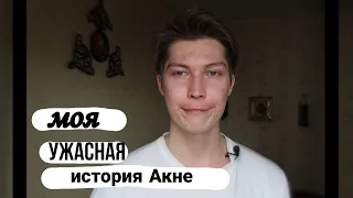 Моя ужасная история акне