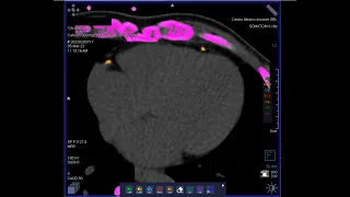 How to perform a cardiac CT scan for TAVI