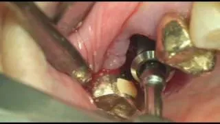 Dentium dental Implant Prosthetic#16 IS~(2''52)