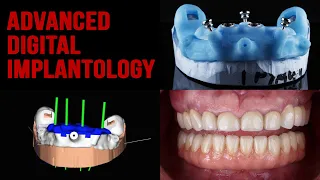 All on Four -  Surgery multicomponent template -  Soft tissue