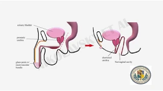 Repair of Prostato-Neovaginal Fistula in Patient with Prior TURP