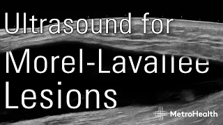Ultrasound for Morel-Lavallée Lesions