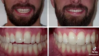 Widening of Smile with Invisalign