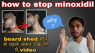 How to stop minoxidil for beard without losing hair|what happens when you quitting using minoxidil