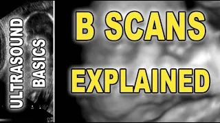 ultrasound/sonogram - B scans explained