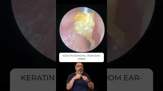 KERATIN REMOVAL FROM EAR - EP829