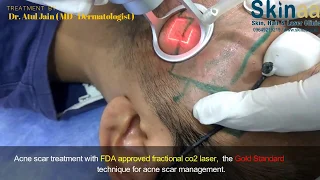 Acne Scar Treatment by FDA Approved Fractional Co2 Laser | Skinaa Clinic