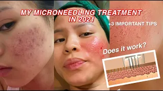 Update on my 2021 microneedling treatments + Tips l ACNE SCARS EDITION