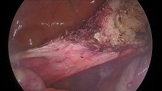 Laparoscopic Subtotal Hysterectomy | Dr Kunal Rathod